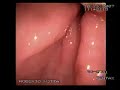 Úlcera Duodenal Úlcera Duodenal