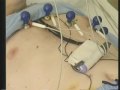 Cos'è lo scompenso cardiaco, come si...