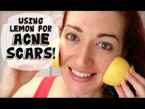 how to lighten acne scars