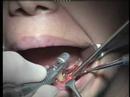 cl-ponte zirconia part1