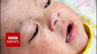 Why is there a measles outbreak in Europe?