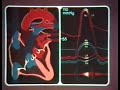 11 - Persistierender Ductus arteriosus botali 11 - Persistierender Ductus arteriosus botali