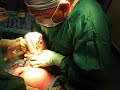 breech-csection.html