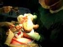 Breech c-section