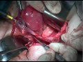 Wertheim,s radical hysterectomy & Pelvic Lymphadenectomy سرطان عنق الرحم