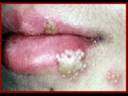 Gonorrhea
