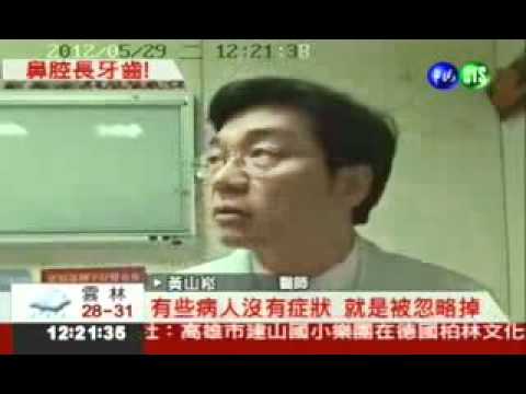 101.05.29 老是流鼻血?!鼻子裡竟長2公分牙(耳鼻喉科黃山崧)