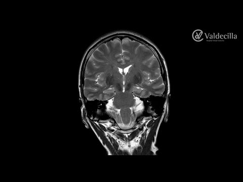 Curso de Epilepsy Imaging en el HVV