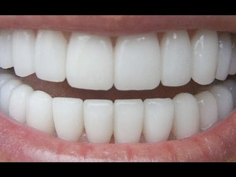 how to whiten teeth in two minutes