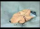 Intestinal Anastomosis, intestine repair lembert suturing of inestines :  connel lembert