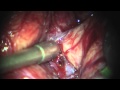 Cirurgia de Aneurisma Cerebral - Brain Aneurysm Surgery - Artéria cerebral media