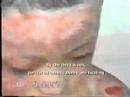 Chinese Burn Medicine