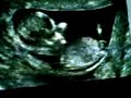 Ecografía 12 semanas Ecografía 12 semanas