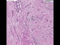 Histopathology Bladder --Urothelial carcinoma Grade III