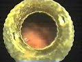 lap_appendectomy lap_appendectomy