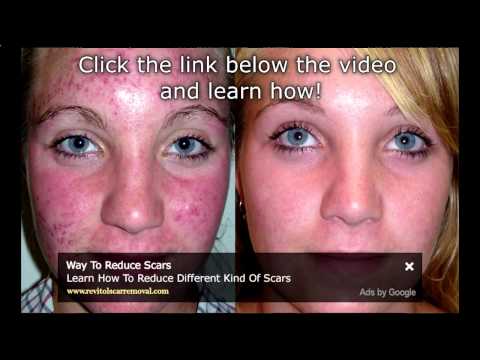 how to treat acne uk