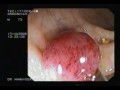 BKS Polypectomy BKS Polypectomy