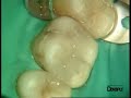 Universal flowable restorative Dr. P. Colon - X Flow /2