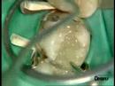 Universal flowable restorative Dr. P. Colon - X Flow /2
