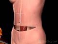 Breast reconstruction in 3D