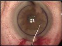Descemet Stripping Automated Endothelial Keratoplasty 3