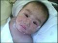 videos de Scalded skin syndrome