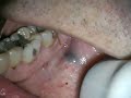 NdYAG Treatment of oral Hemangioma