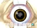 PreOp® Patient Education Cataract Small Incision Surgery 3
