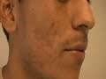 The Acne Practice (Spanish 3) The Acne Practice (Spanish 3)
