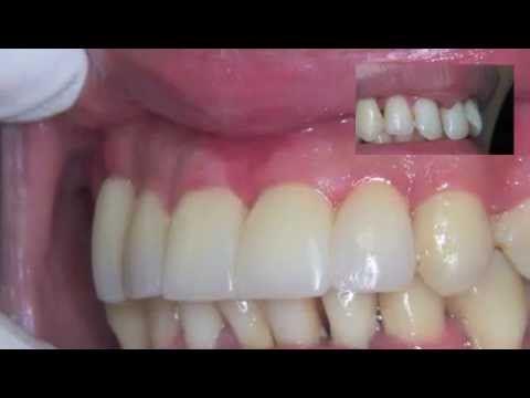 gencive - http://dr-nahon-jacques.chirurgiens-dentistes.fr/ Traitement réalisé par le docteur Jacques Nahon chirurgien dentiste à Paris en 2012. On montre la transform...