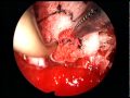 Endonasal Endoscopy - Tumor Endonasal Endoscopy - Tumor