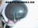 keratoconus
