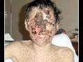 enfermedades raras - Rare Diseases