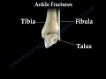 Ankle  fracture / Fractures and its repair- Everything You Need To Know - Dr. Nabil Ebraheim