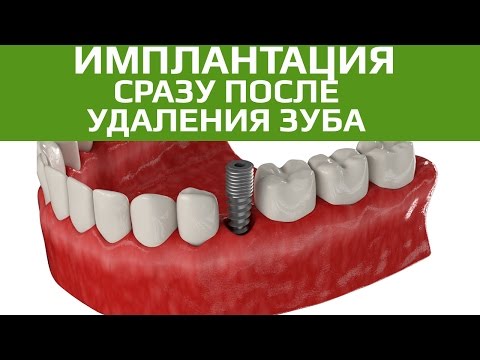 Одномоментная имплантация