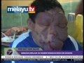 penyakit kaki galah - mangsa dirujuk ke kementerian kesihatan segera.
