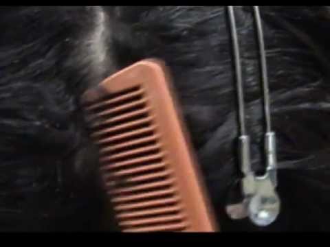 how to cure severe dandruff