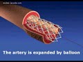 Angioplasty, stent procedure, Fred Vagle, June 4, 2007