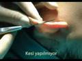 Op.Dr. Bülent Cihantimur iple kepçe kulak estetiği