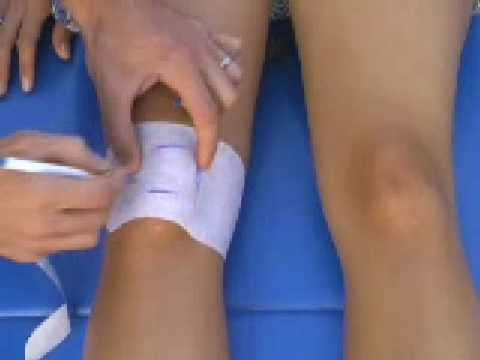 Patellofemoral McConnell taping