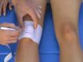 Patellofemoral McConnell taping