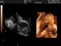 Baby in Stomach Baby in Stomach