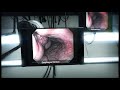 Esophageal Varices