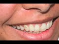 PHOTO SHOP - DIENTES BLANCOS