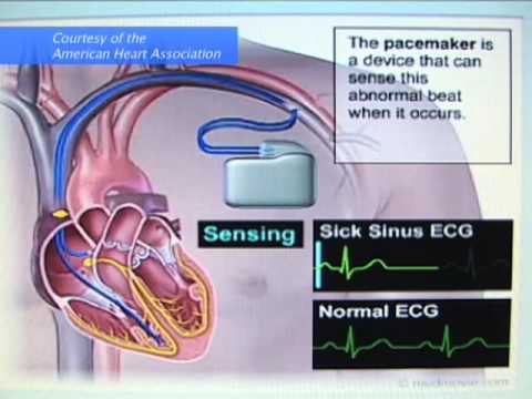 how to treat arrhythmia