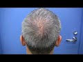 Hair Transplant - AJ\ Hair Transplant - AJ\