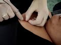 2nd movie for Dermal Implant 2nd movie for Dermal Implant
