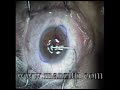 LASIK EYE SURGERY in Real Time LASIK EYE SURGERY in Real Time