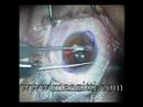 LASIK EYE SURGERY in Real Time