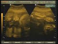 Ecografia de nuestro bebe - Carol y Elkim